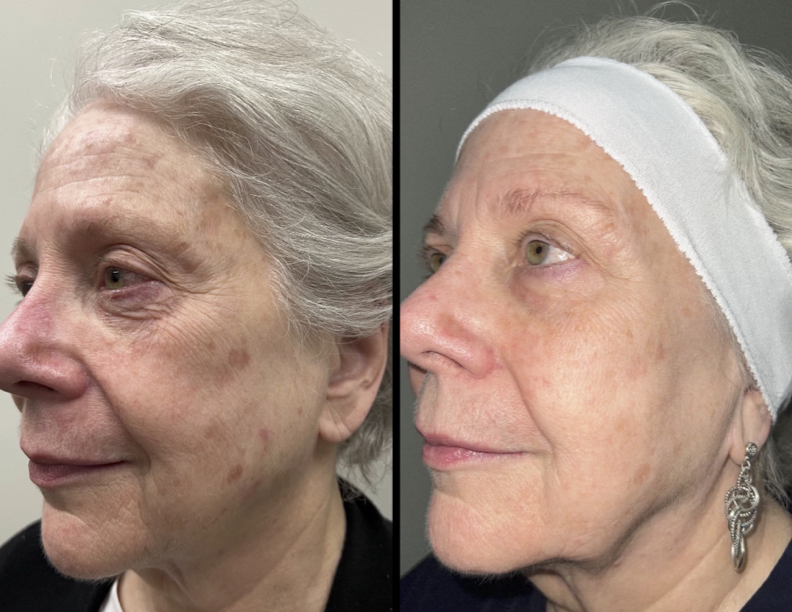 Before and after photos of a patient who received IPL for dry eye treatment