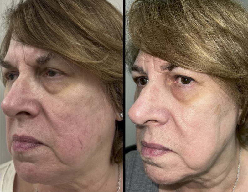 Before and after photos of a patient who received IPL for dry eye treatment