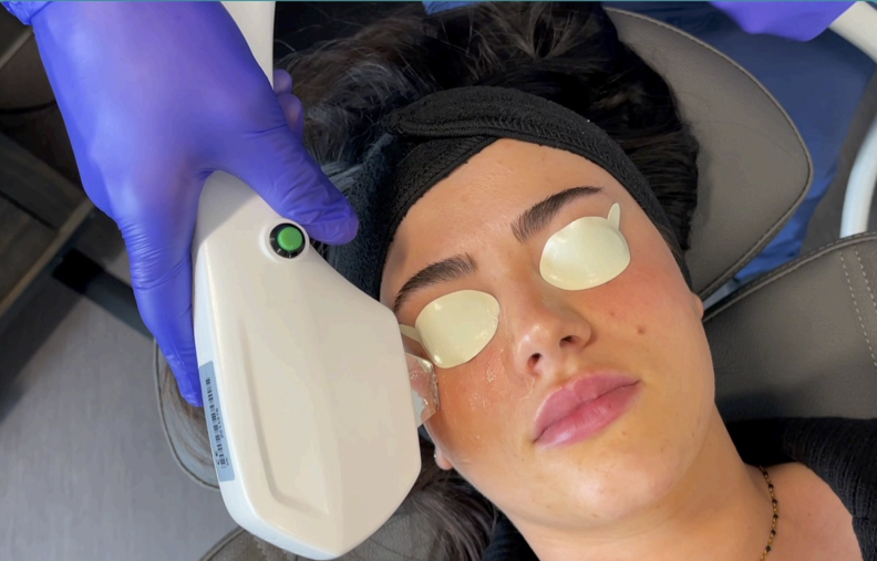 A photo of a patient receiving IPL for dry eye treatment