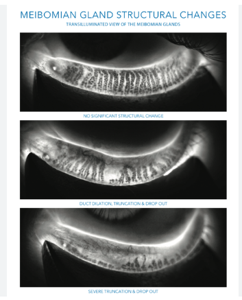 A graphic describing meibomian gland structural changes